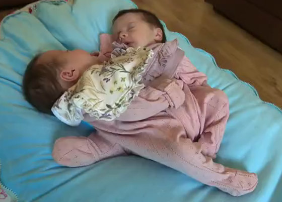 فيديو وصور توأم ملتصق.. معجزة وحالة نادرة! ماذا يقول الوالدان وهل ستتم عملية الفصل؟ صورة رقم 1 فيديو وصور توأم ملتصق.. معجزة وحالة نادرة! ماذا يقول الوالدان وهل ستتم عملية الفصل؟ صورة رقم 1