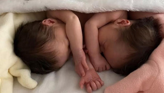 فيديو وصور توأم ملتصق.. معجزة وحالة نادرة! ماذا يقول الوالدان وهل ستتم عملية الفصل؟ صورة رقم 6 فيديو وصور توأم ملتصق.. معجزة وحالة نادرة! ماذا يقول الوالدان وهل ستتم عملية الفصل؟ صورة رقم 6