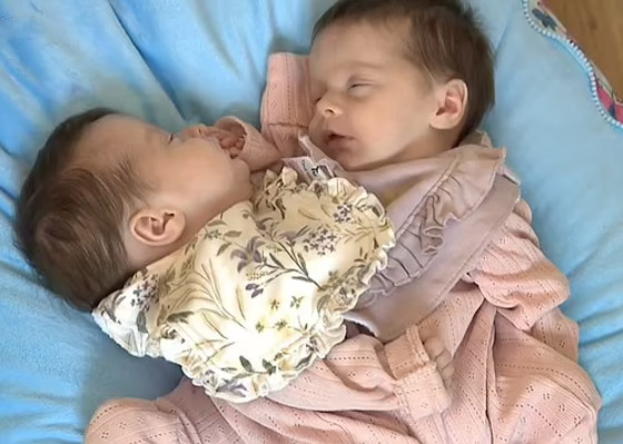 فيديو وصور توأم ملتصق.. معجزة وحالة نادرة! ماذا يقول الوالدان وهل ستتم عملية الفصل؟ صورة رقم 8 فيديو وصور توأم ملتصق.. معجزة وحالة نادرة! ماذا يقول الوالدان وهل ستتم عملية الفصل؟ صورة رقم 8