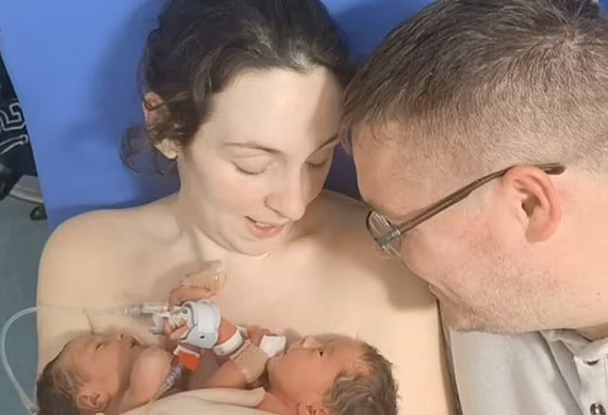 فيديو وصور توأم ملتصق.. معجزة وحالة نادرة! ماذا يقول الوالدان وهل ستتم عملية الفصل؟ صورة رقم 9 فيديو وصور توأم ملتصق.. معجزة وحالة نادرة! ماذا يقول الوالدان وهل ستتم عملية الفصل؟ صورة رقم 9