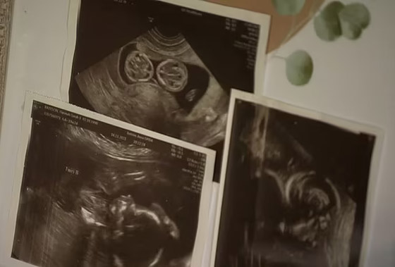 فيديو وصور توأم ملتصق.. معجزة وحالة نادرة! ماذا يقول الوالدان وهل ستتم عملية الفصل؟ صورة رقم 11 فيديو وصور توأم ملتصق.. معجزة وحالة نادرة! ماذا يقول الوالدان وهل ستتم عملية الفصل؟ صورة رقم 11