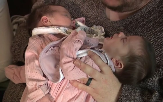 فيديو وصور توأم ملتصق.. معجزة وحالة نادرة! ماذا يقول الوالدان وهل ستتم عملية الفصل؟ صورة رقم 12 فيديو وصور توأم ملتصق.. معجزة وحالة نادرة! ماذا يقول الوالدان وهل ستتم عملية الفصل؟ صورة رقم 12