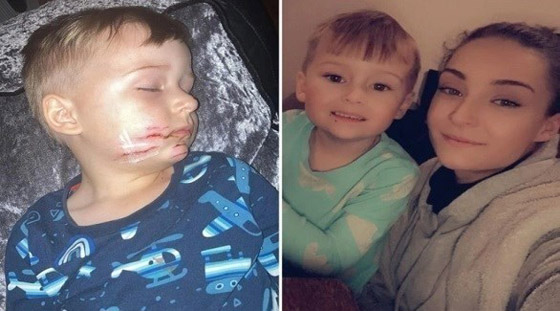 طفل ينجو من الموت بفضل جراحة تم خلالها لصق أجزاء وجهه ببعضها صورة رقم 1