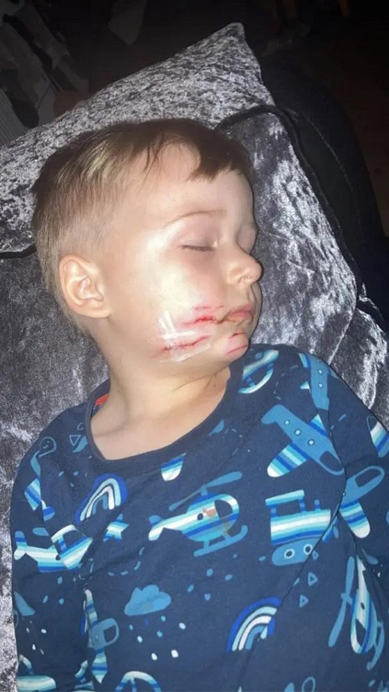 طفل ينجو من الموت بفضل جراحة تم خلالها لصق أجزاء وجهه ببعضها صورة رقم 2