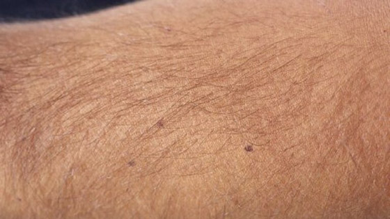 تطبيق عبر الهاتف يساعد على اكتشاف سرطان الجلد صورة رقم 1