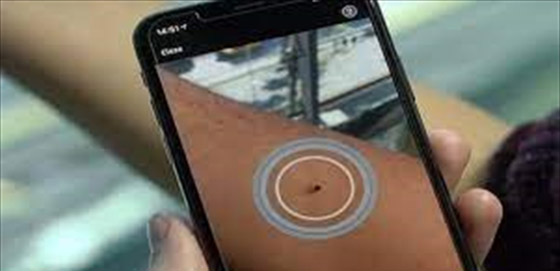 تطبيق عبر الهاتف يساعد على اكتشاف سرطان الجلد صورة رقم 4