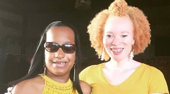 تتحدى حالة نادرة تسببت بـ 100 كسر في جسمها صورة رقم 1