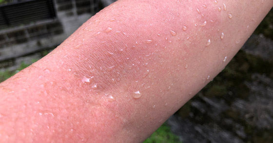 تعاني من حساسية تجاه الماء تمنعها من الشرب وذرف الدموع صورة رقم 2