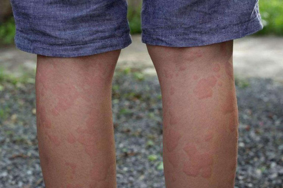 تعاني من حساسية تجاه الماء تمنعها من الشرب وذرف الدموع صورة رقم 4