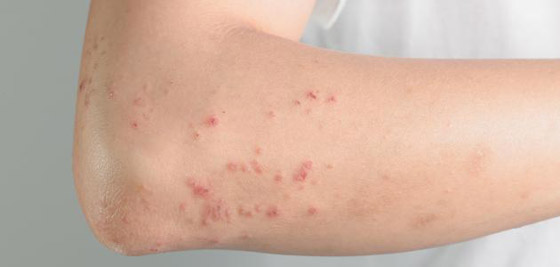 تعاني من حساسية تجاه الماء تمنعها من الشرب وذرف الدموع صورة رقم 5