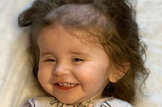 طفلة تأكل خصلات شعرها بسبب حالة صحية نادرة صورة رقم 2