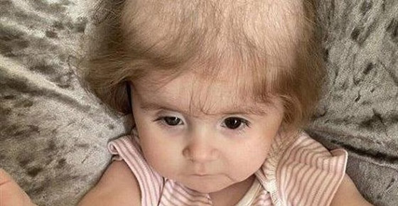 طفلة تأكل خصلات شعرها بسبب حالة صحية نادرة صورة رقم 3