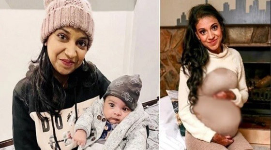 صور...تصاب بحروق شديدة أثناء المخاض بسبب حالة صحية نادرة صورة رقم 1