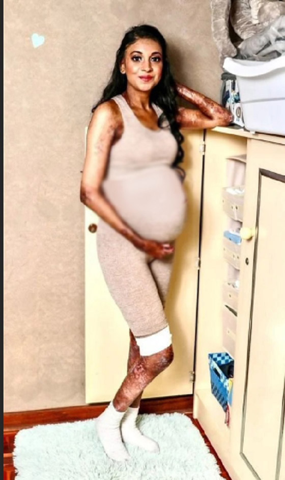 صور...تصاب بحروق شديدة أثناء المخاض بسبب حالة صحية نادرة صورة رقم 3