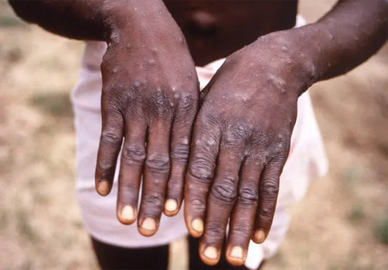 كيف يبدو جدري القردة؟ 6 رسومات تكشف تغييرات الجلد يجب الانتباه إليها صورة رقم 2 كيف يبدو جدري القردة؟ 6 رسومات تكشف تغييرات الجلد يجب الانتباه إليها صورة رقم 2