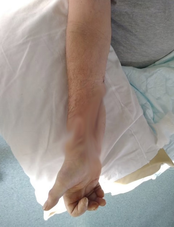 يخضع لأول عملية زرع يد مزدوجة في العالم بعدما أصيب بتصلب الجلد صورة رقم 2