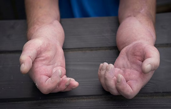 يخضع لأول عملية زرع يد مزدوجة في العالم بعدما أصيب بتصلب الجلد صورة رقم 3