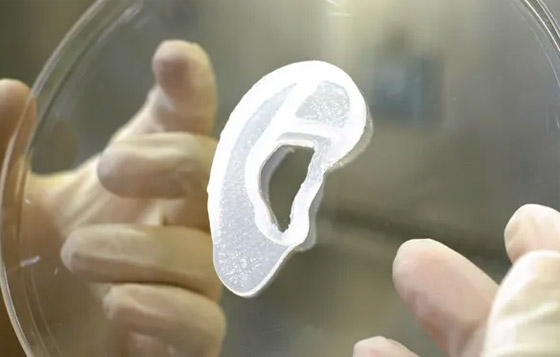 الأولى من نوعها.. عملية زرع أذن مطبوعة لكنها 