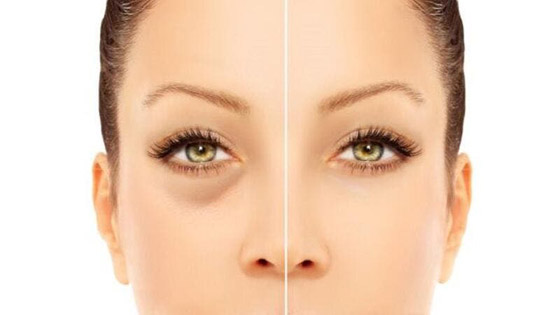 6 نصائح لعلاج الهالات السوداء صورة رقم 4