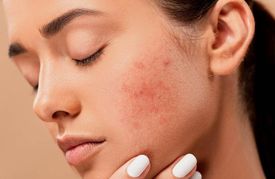 البثور الشائعة تصيب الكثيرين.. 6 أنواع والحل مختلف لكل منها صورة رقم 1