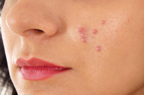 البثور الشائعة تصيب الكثيرين.. 6 أنواع والحل مختلف لكل منها صورة رقم 3