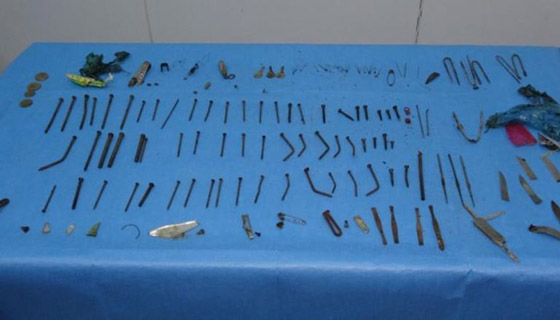 بينها مقص وسكين وإبر.. فتاة تركية تبتلع حقيبة معدات صورة رقم 1