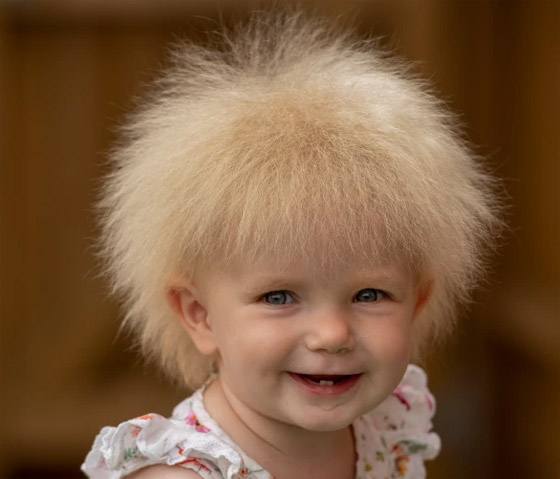 متلازمة نادرة.. رضيعة تثير الجدل بشدة شبهها لبوريس جونسون... شاهد صورة رقم 4