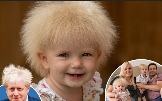 متلازمة نادرة.. رضيعة تثير الجدل بشدة شبهها لبوريس جونسون... شاهد صورة رقم 1