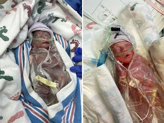 تنجب طفلتين توأم إحداهما أصغر بثلاث مرات من الأخرى صورة رقم 4