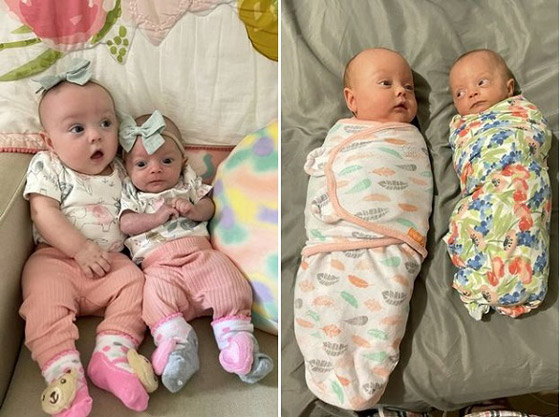 تنجب طفلتين توأم إحداهما أصغر بثلاث مرات من الأخرى صورة رقم 2