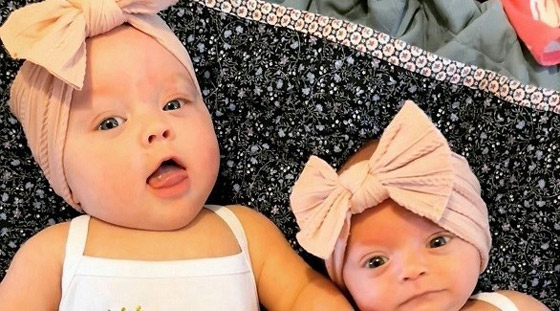 تنجب طفلتين توأم إحداهما أصغر بثلاث مرات من الأخرى صورة رقم 1