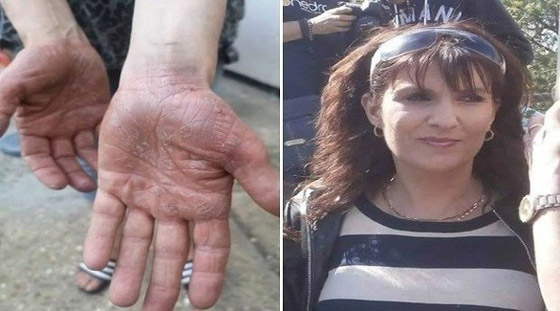 اعتقدت أن حكة يديها من منتجات التنظيف.. فاكتشف أنها مصابة بالسرطان صورة رقم 1