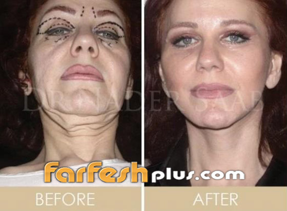 بالصور: ميادة الحناوي تبدو بالعشرينات بعد عملية تجميل تغير ملامحها صورة رقم 1 بالصور: ميادة الحناوي تبدو بالعشرينات بعد عملية تجميل تغير ملامحها صورة رقم 1
