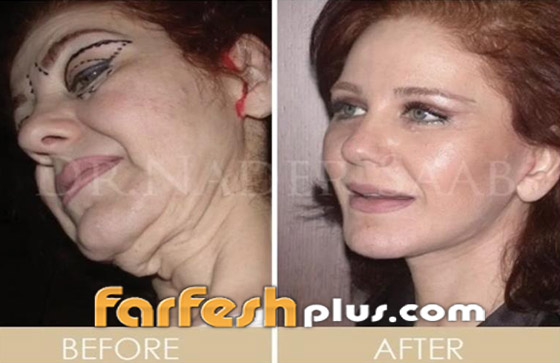 بالصور: ميادة الحناوي تبدو بالعشرينات بعد عملية تجميل تغير ملامحها صورة رقم 2 بالصور: ميادة الحناوي تبدو بالعشرينات بعد عملية تجميل تغير ملامحها صورة رقم 2