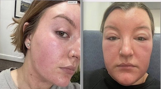 تنسى وضع الواقي الشمسي فيزداد حجم وجهها بمقدار الضعفين صورة رقم 1