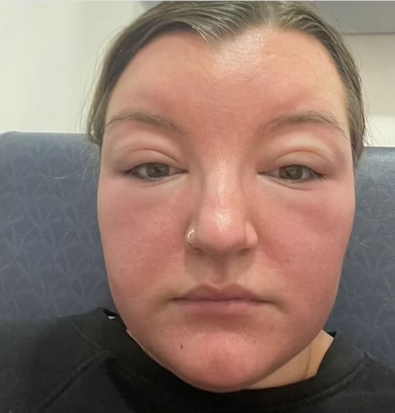 تنسى وضع الواقي الشمسي فيزداد حجم وجهها بمقدار الضعفين صورة رقم 6