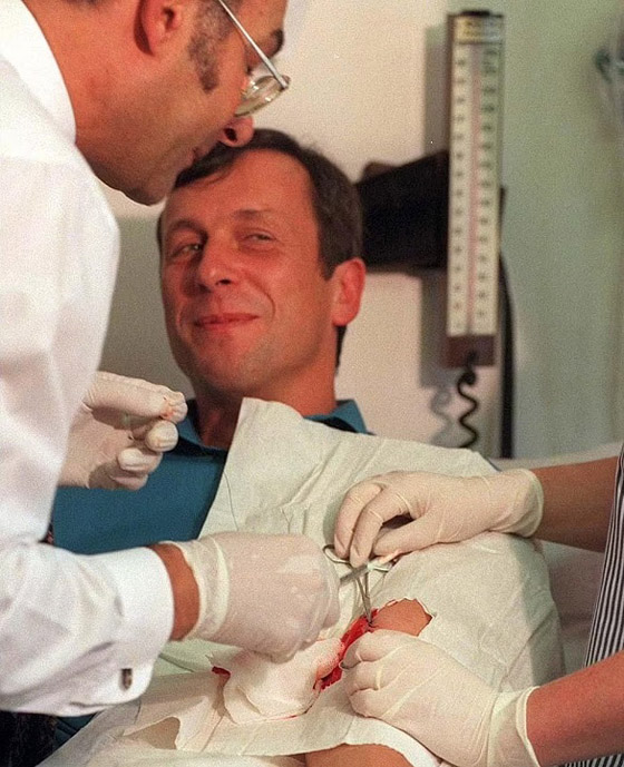 أغرب حالات لأشخاص زرعوا أجهزة إلكترونية في أجسامهم صورة رقم 2