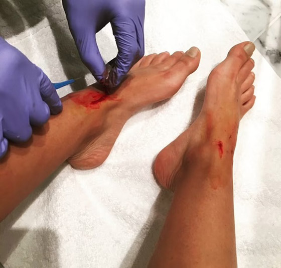 أغرب حالات لأشخاص زرعوا أجهزة إلكترونية في أجسامهم صورة رقم 6