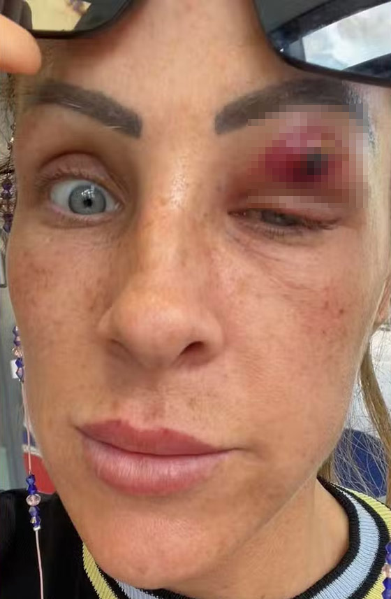 كأفلام الخيال العلمي: طفيلي يخرج من عين سيدة بعد تسلله داخل جسدها! صورة رقم 2