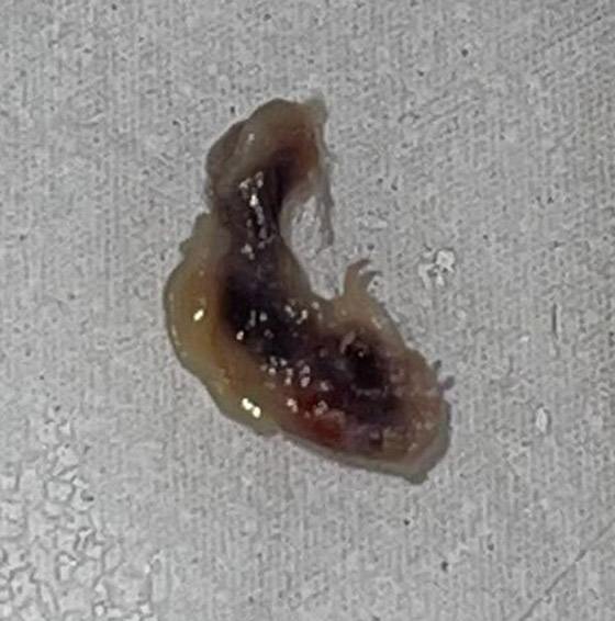 كأفلام الخيال العلمي: طفيلي يخرج من عين سيدة بعد تسلله داخل جسدها! صورة رقم 3