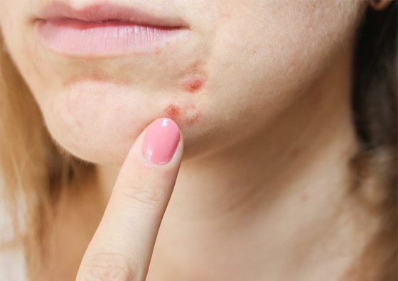 هكذا يمكنكم إزالة آثار الحبوب من البشرة باستخدام مكونات طبيعية صورة رقم 2