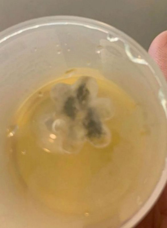 صور: إخراج وردة بلاستيكية من حنجرة طفل بعد 5 سنوات من المعاناة صورة رقم 3