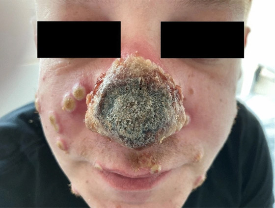 صورة مقززة.. شاهد كيف تعفن أنف مصاب بفيروس جدري القرود! صورة رقم 1 صورة مقززة.. شاهد كيف تعفن أنف مصاب بفيروس جدري القرود! صورة رقم 1