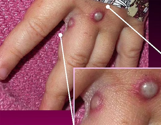 صورة مقززة.. شاهد كيف تعفن أنف مصاب بفيروس جدري القرود! صورة رقم 7 صورة مقززة.. شاهد كيف تعفن أنف مصاب بفيروس جدري القرود! صورة رقم 7