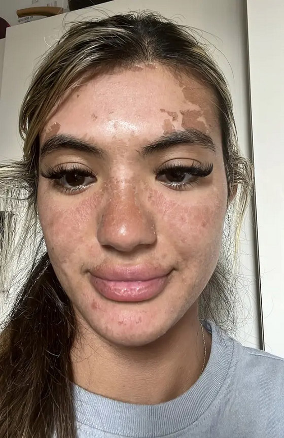 بسبب الشمس...جبين شابة يتحول إلى قطعة بلاستيك(صور) صورة رقم 3