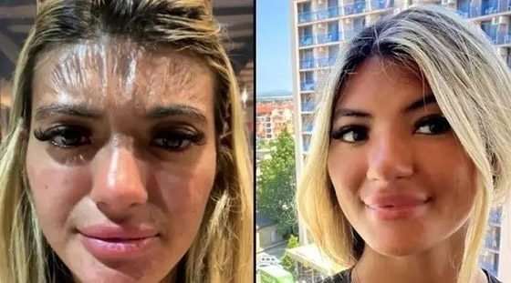 بسبب الشمس...جبين شابة يتحول إلى قطعة بلاستيك(صور) صورة رقم 1