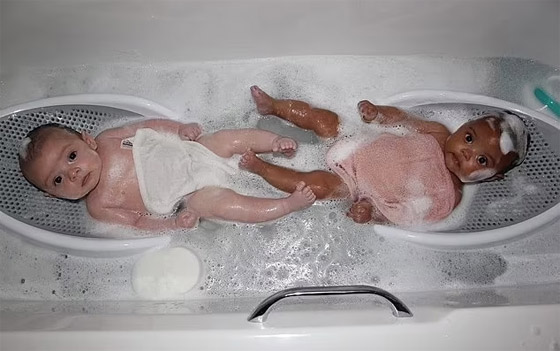 في حالة من مليون.. توأم بريطاني بلوني بشرتين مختلفين تماما صورة رقم 6