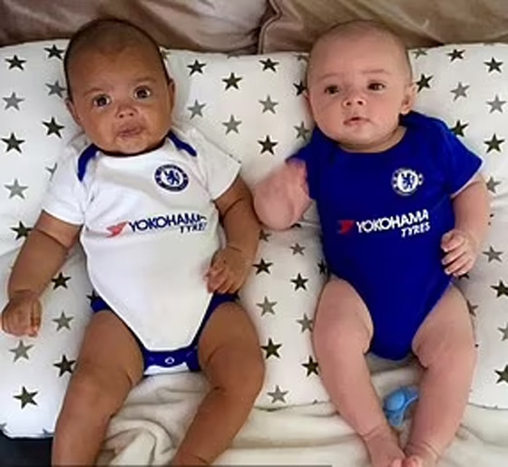 في حالة من مليون.. توأم بريطاني بلوني بشرتين مختلفين تماما صورة رقم 8