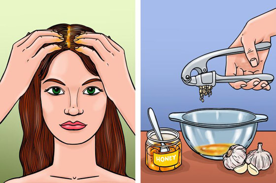 اليكم افضل 5 وصفات لمكافحة قشرة الرأس صورة رقم 6