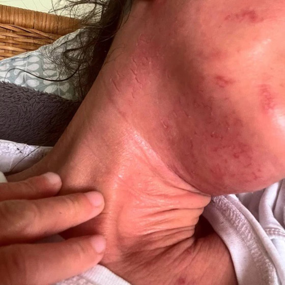 تمتنع عن مغادرة المنزل بسبب كريم للأكزيما ! صورة رقم 2